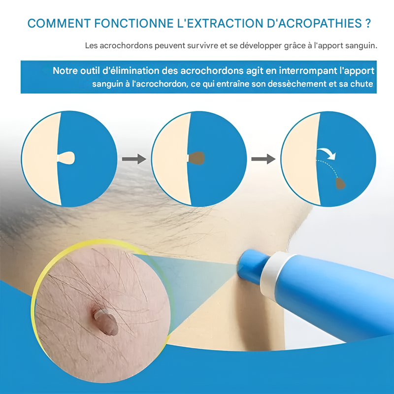 Entfernungskit für Hautanhängsel - Einfache Kryotherapie